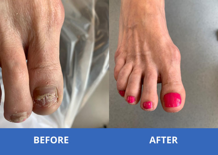 Toe Nail Reconstruction