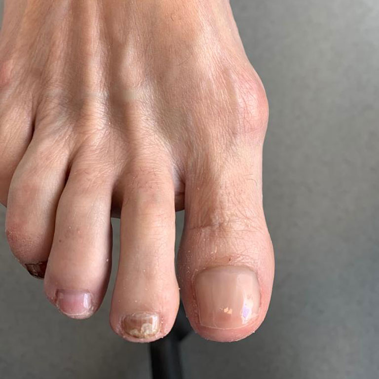 Treatments Chiropody, Podiatry, Biomechanics Colne Valley & Huddersfield