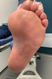 soft skin following removal of callus