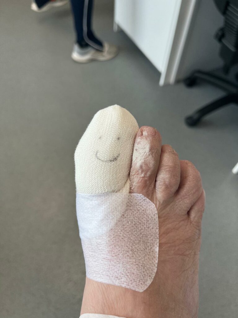 Bandaged foot, following Nail Surgery.